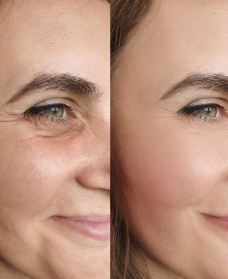 Neuromodulator Injections