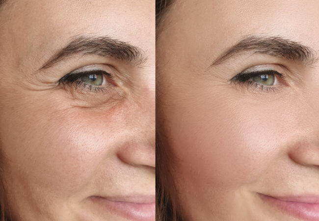 Neuromodulator Injections